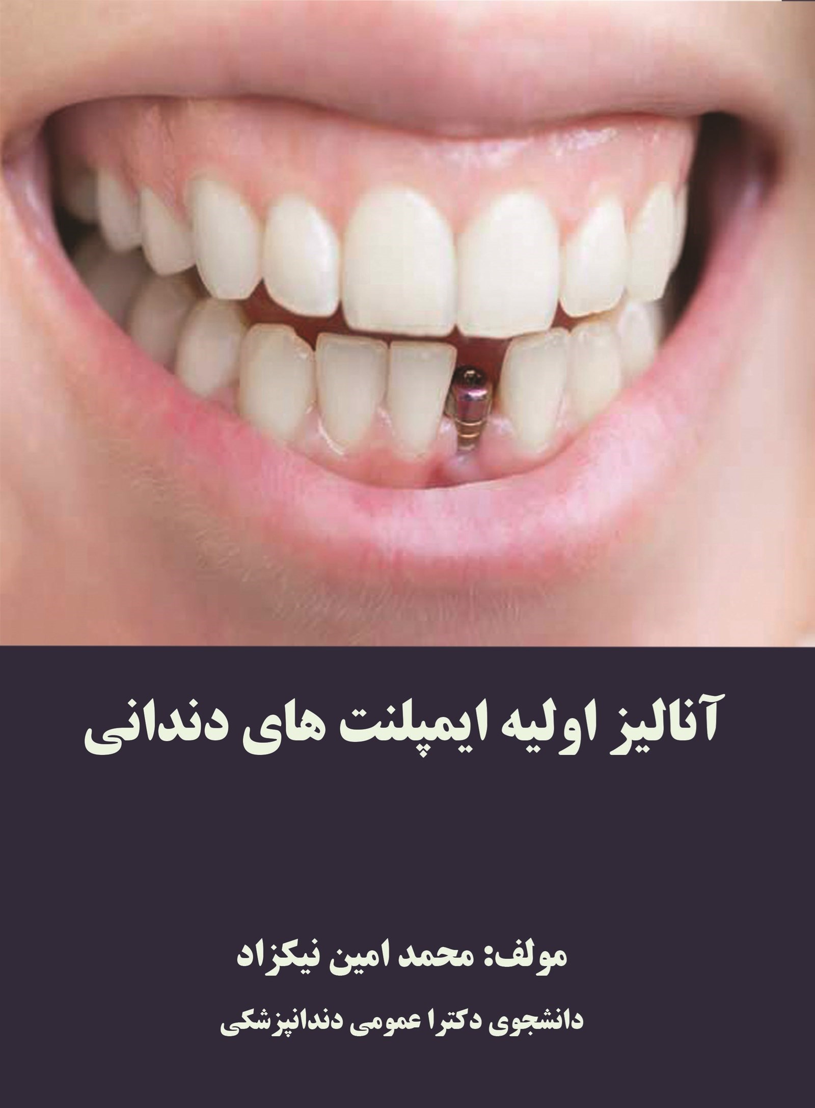 تصویر جلد کتاب تحلیل و انواع ایمپلنت‌های دندان